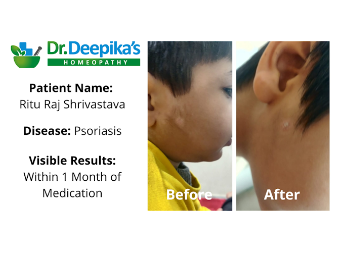 Before and after treatment images of a child patient showing visible improvement